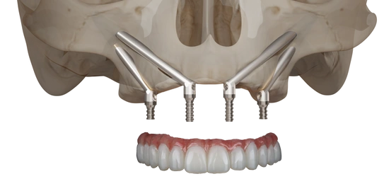 Protesica Zygoma+ – Biologitech Srl, Composants et piliers d'implants