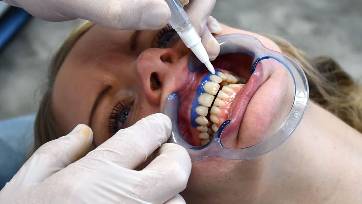 Cavex Bite&White Shade Correction – Cavex Holland BV, Bleaching