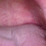 SNORE3 – Elexxion, Dental Lasers