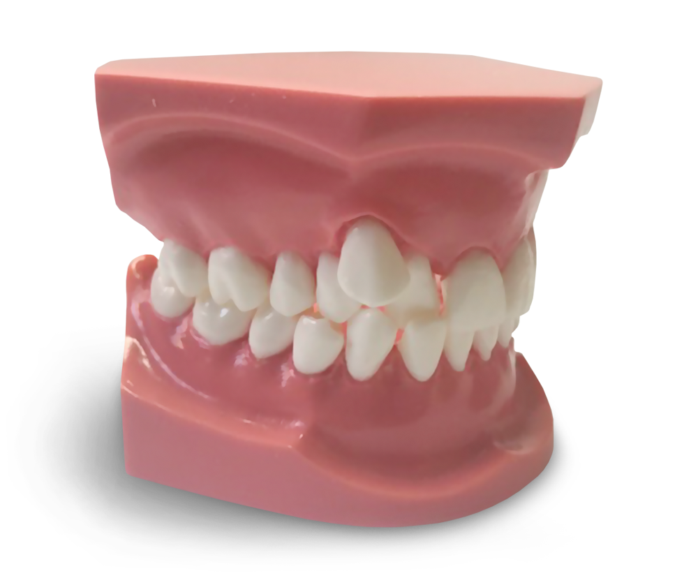 ORB05 - Modèle orthodontique avec éruption canine ectopique – GF Dental di Ficuciello Antonino, Demonstration Models