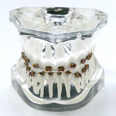 Transparent orthodontic model 2 class 2 division