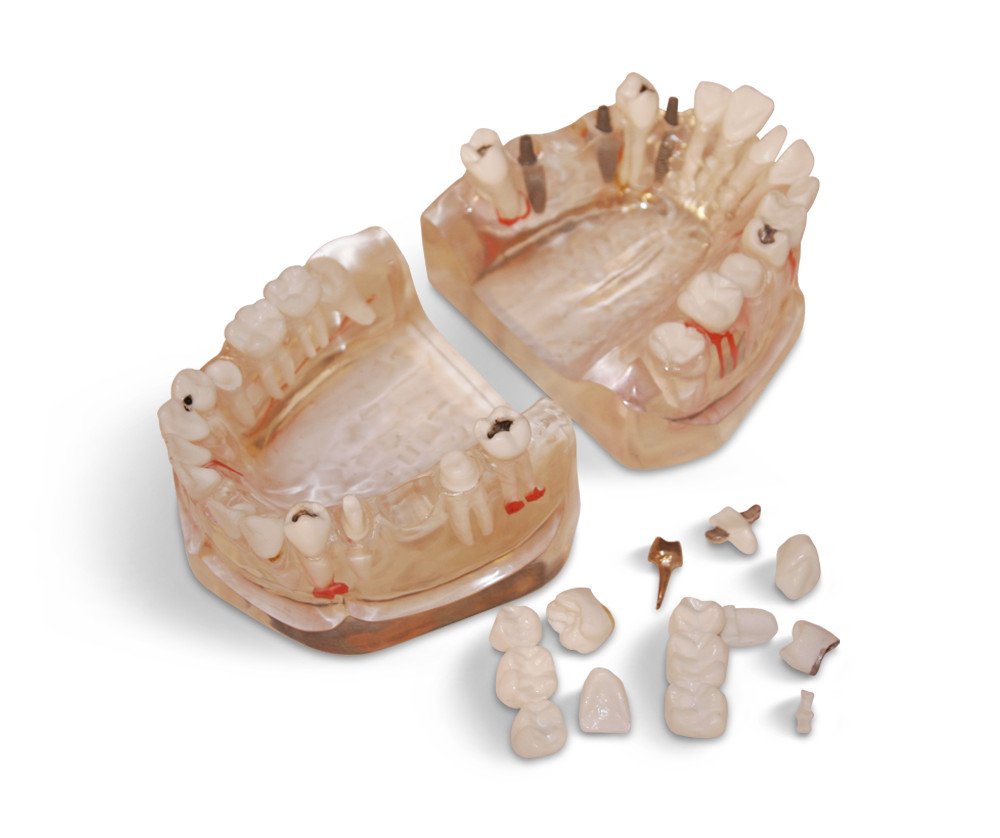 Significantly enlarged model in 3:1 scale – GF Dental di Ficuciello Antonino, Gipszusätze, Stumpflacke und Gipslöser