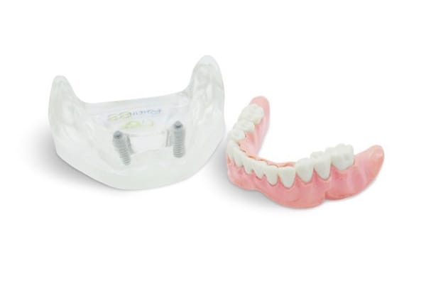 Lower overdenture model