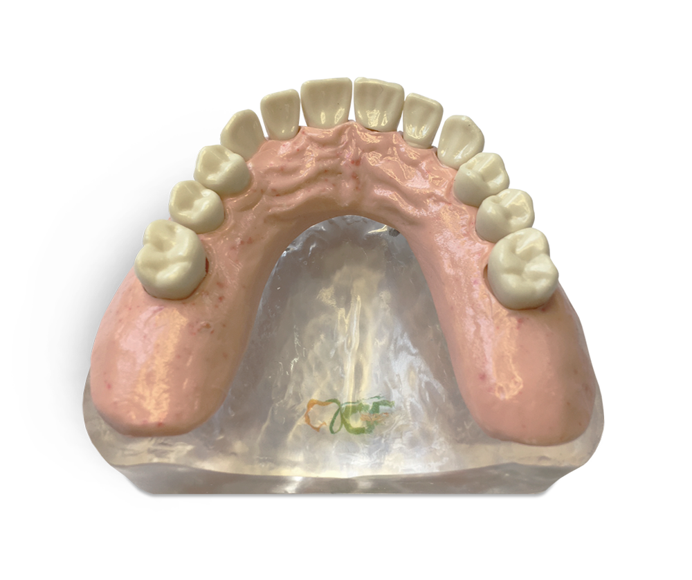 Upper overdenture model – GF Dental di Ficuciello Antonino, Prothetikgeräte