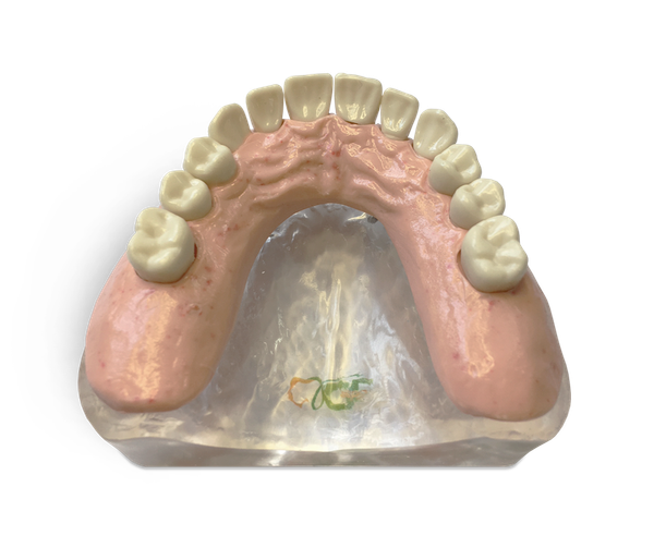 Upper overdenture model