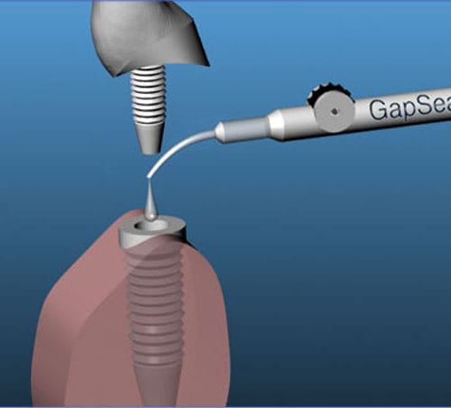 GapSeal Applikator