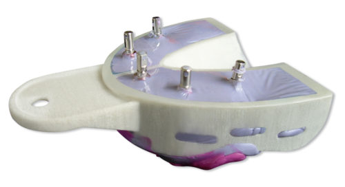 Miratray® Implant