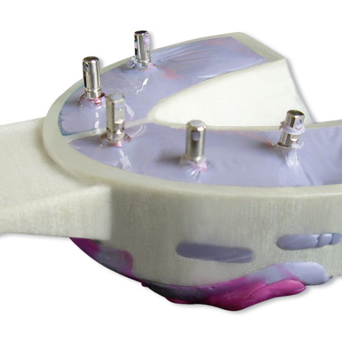 Miratray® Implant
