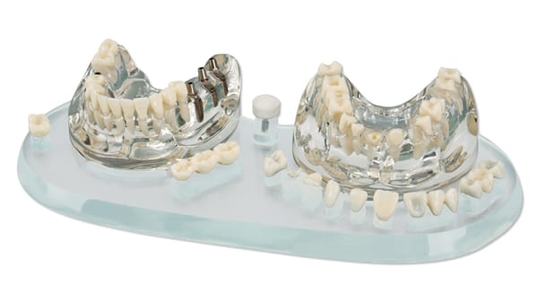 Demonstrationsmodell Implantat Krone + Brücke
