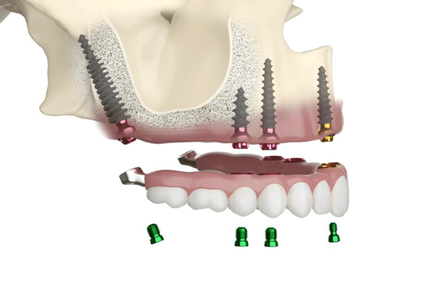 ROOTT M Implant