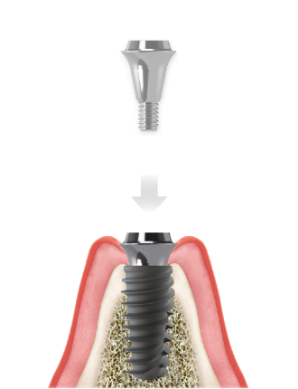 Highness Implant-System Digitale Prothetik – Highness Implant System, Other