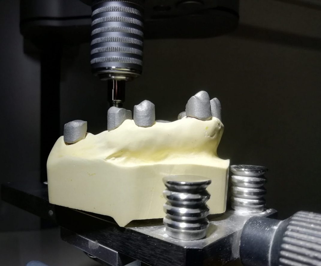 i-PD Teleskopprothetik mit CoCr SLM