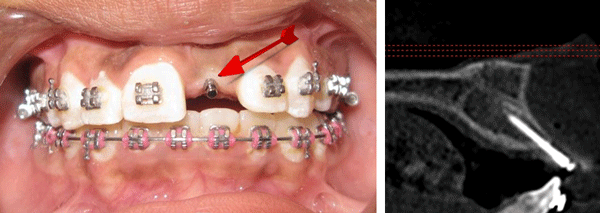 Templant™ – IOS International Orthodontic Services, Implantologie