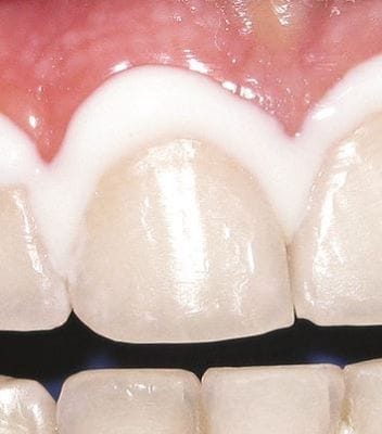 Liquid Dam 3-ml-Spritze – Stück – IOS International Orthodontic Services, Kofferdam