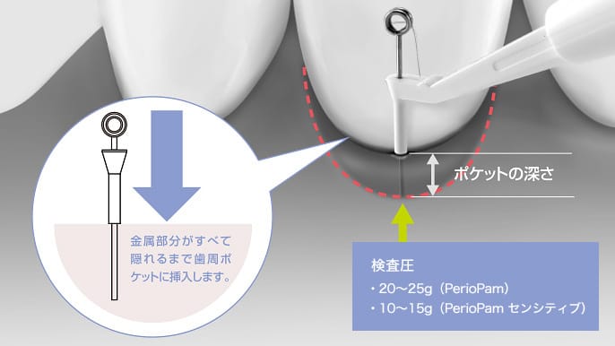 Parodontaltaschen-Messgerät PerioPam (ペリオパム) – Narcohm Co., Ltd., Diagnostik