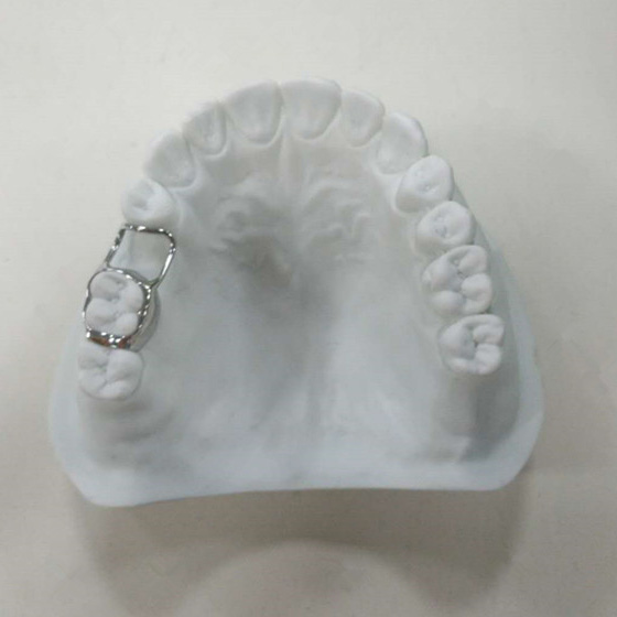 Space Maintainer – New Perfect Dental Lab, Intraoral Appliances