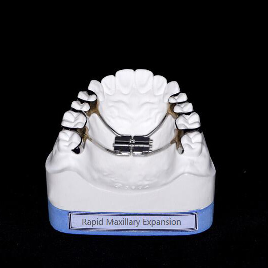 Rapid Maxillary Expansion – New Perfect Dental Lab, Intraoral Appliances