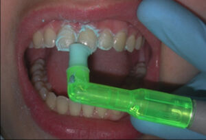 2pro® Disposable Prophy Angle