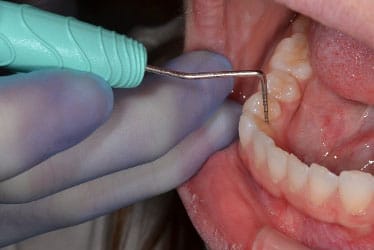 PremierAir® – Premier Dental, Sonden