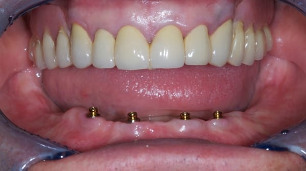 OT EQUATOR ATAČMENT: ZA SVE IMPLANT PLATFORME