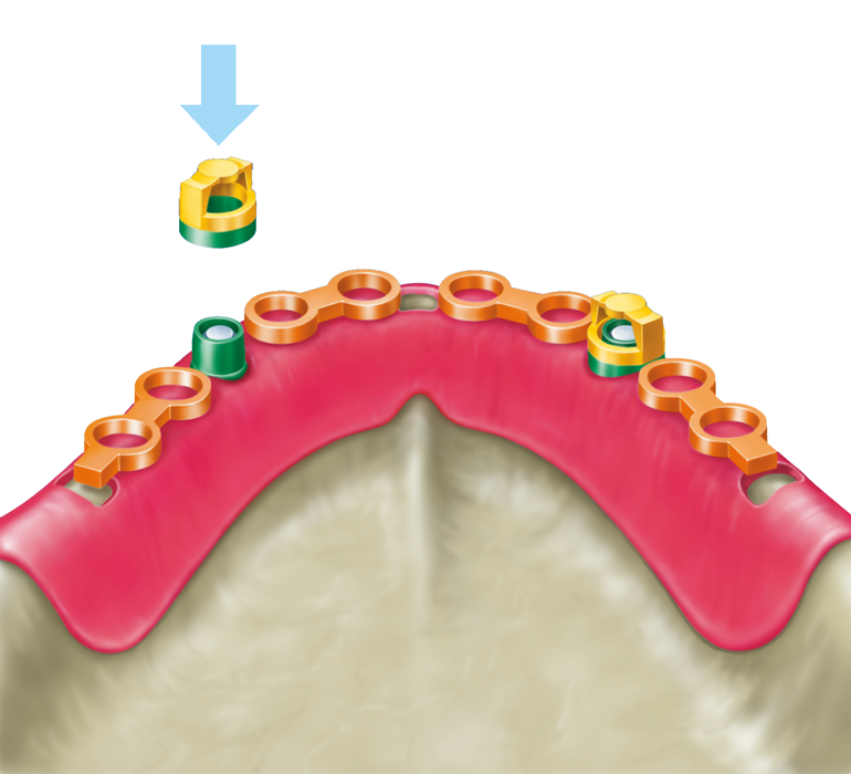 Base profiles for ball anchors