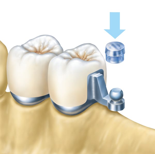 Kugelanker horizontal