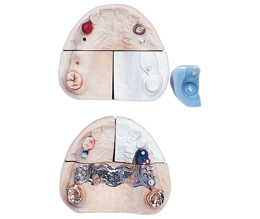 Paracon – Servo-Dental, Attachment Systems