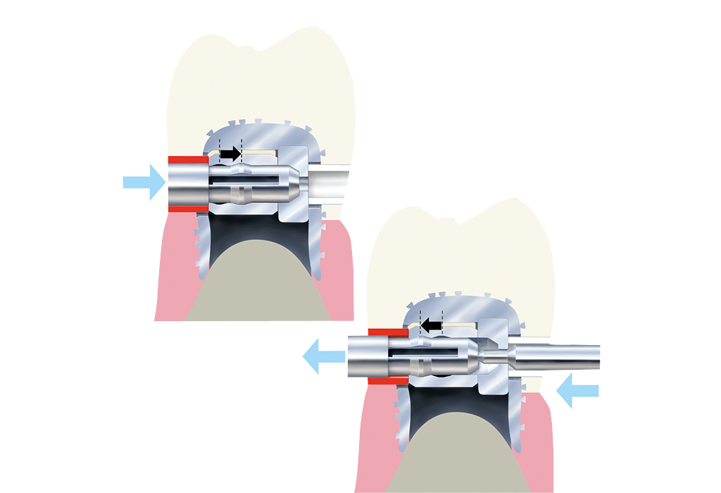 Snap-Slot latch – Servo-Dental, Attachment Systems