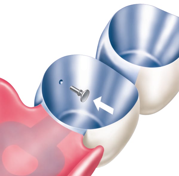 Tele-Fit Friction Parts