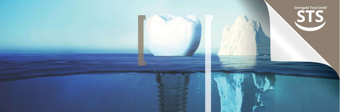 STS4 : Prothèse supra-implantaire conventionnelle – Sterngold Dental, LLC, Implants